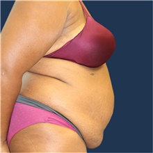 Tummy Tuck Before Photo by Laurence Glickman, MD, MSc, FRCS(c),  FACS; Garden City, NY - Case 43243