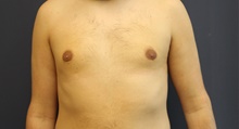 Male Breast Reduction After Photo by Laurence Glickman, MD, MSc, FRCS(c),  FACS; Garden City, NY - Case 43244