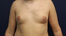 Male Breast Reduction Before Photo by Laurence Glickman, MD, MSc, FRCS(c),  FACS; Garden City, NY - Case 43244