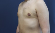 Male Breast Reduction After Photo by Laurence Glickman, MD, MSc, FRCS(c),  FACS; Garden City, NY - Case 43244