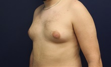 Male Breast Reduction Before Photo by Laurence Glickman, MD, MSc, FRCS(c),  FACS; Garden City, NY - Case 43244