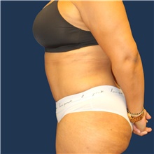 Tummy Tuck After Photo by Laurence Glickman, MD, MSc, FRCS(c),  FACS; Garden City, NY - Case 44778