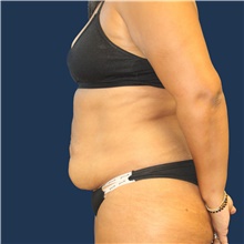 Tummy Tuck Before Photo by Laurence Glickman, MD, MSc, FRCS(c),  FACS; Garden City, NY - Case 44778