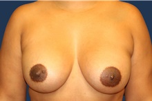 Breast Augmentation After Photo by Laurence Glickman, MD, MSc, FRCS(c),  FACS; Garden City, NY - Case 44779