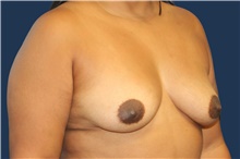 Breast Augmentation Before Photo by Laurence Glickman, MD, MSc, FRCS(c),  FACS; Garden City, NY - Case 44779