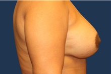 Breast Augmentation After Photo by Laurence Glickman, MD, MSc, FRCS(c),  FACS; Garden City, NY - Case 44779