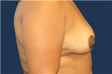 Breast Augmentation Before Photo by Laurence Glickman, MD, MSc, FRCS(c),  FACS; Garden City, NY - Case 44779