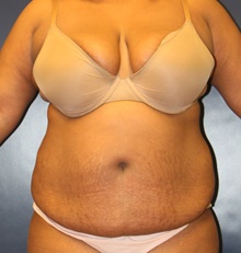 Tummy Tuck Before Photo by Laurence Glickman, MD, MSc, FRCS(c),  FACS; Garden City, NY - Case 44780
