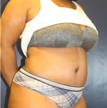 Tummy Tuck After Photo by Laurence Glickman, MD, MSc, FRCS(c),  FACS; Garden City, NY - Case 44780