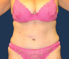 Tummy Tuck After Photo by Laurence Glickman, MD, MSc, FRCS(c),  FACS; Garden City, NY - Case 44781