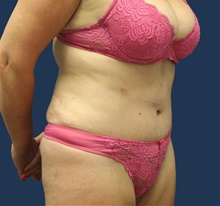 Tummy Tuck After Photo by Laurence Glickman, MD, MSc, FRCS(c),  FACS; Garden City, NY - Case 44781