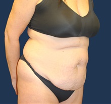 Tummy Tuck Before Photo by Laurence Glickman, MD, MSc, FRCS(c),  FACS; Garden City, NY - Case 44781
