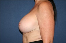 Breast Augmentation After Photo by Laurence Glickman, MD, MSc, FRCS(c),  FACS; Garden City, NY - Case 44783