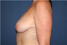 Breast Augmentation Before Photo by Laurence Glickman, MD, MSc, FRCS(c),  FACS; Garden City, NY - Case 44783