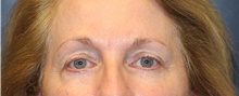 Eyelid Surgery After Photo by Laurence Glickman, MD, MSc, FRCS(c),  FACS; Garden City, NY - Case 44784