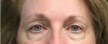 Eyelid Surgery Before Photo by Laurence Glickman, MD, MSc, FRCS(c),  FACS; Garden City, NY - Case 44784