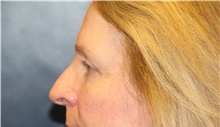 Eyelid Surgery After Photo by Laurence Glickman, MD, MSc, FRCS(c),  FACS; Garden City, NY - Case 44784