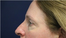 Eyelid Surgery Before Photo by Laurence Glickman, MD, MSc, FRCS(c),  FACS; Garden City, NY - Case 44784