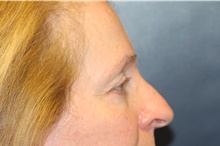 Eyelid Surgery After Photo by Laurence Glickman, MD, MSc, FRCS(c),  FACS; Garden City, NY - Case 44784