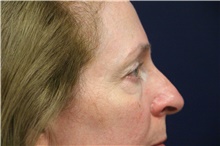 Eyelid Surgery Before Photo by Laurence Glickman, MD, MSc, FRCS(c),  FACS; Garden City, NY - Case 44784