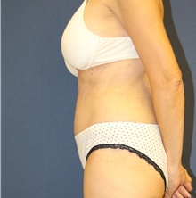 Tummy Tuck After Photo by Laurence Glickman, MD, MSc, FRCS(c),  FACS; Garden City, NY - Case 44787