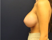 Breast Reduction Before Photo by Laurence Glickman, MD, MSc, FRCS(c),  FACS; Garden City, NY - Case 44790