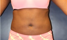 Liposuction After Photo by Laurence Glickman, MD, MSc, FRCS(c),  FACS; Garden City, NY - Case 44791