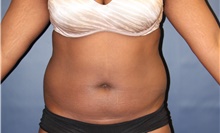 Liposuction Before Photo by Laurence Glickman, MD, MSc, FRCS(c),  FACS; Garden City, NY - Case 44791