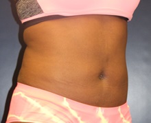 Liposuction After Photo by Laurence Glickman, MD, MSc, FRCS(c),  FACS; Garden City, NY - Case 44791