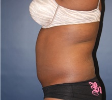 Liposuction Before Photo by Laurence Glickman, MD, MSc, FRCS(c),  FACS; Garden City, NY - Case 44791