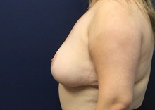 Breast Reduction After Photo by Laurence Glickman, MD, MSc, FRCS(c),  FACS; Garden City, NY - Case 44792