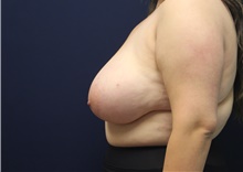 Breast Reduction Before Photo by Laurence Glickman, MD, MSc, FRCS(c),  FACS; Garden City, NY - Case 44792