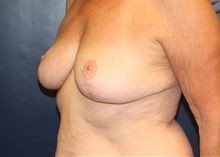 Breast Reduction After Photo by Laurence Glickman, MD, MSc, FRCS(c),  FACS; Garden City, NY - Case 44793