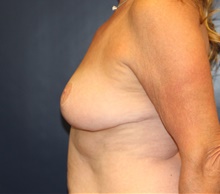 Breast Reduction After Photo by Laurence Glickman, MD, MSc, FRCS(c),  FACS; Garden City, NY - Case 44793