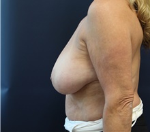 Breast Reduction Before Photo by Laurence Glickman, MD, MSc, FRCS(c),  FACS; Garden City, NY - Case 44793