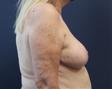 Breast Reduction After Photo by Laurence Glickman, MD, MSc, FRCS(c),  FACS; Garden City, NY - Case 44794