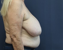 Breast Reduction Before Photo by Laurence Glickman, MD, MSc, FRCS(c),  FACS; Garden City, NY - Case 44794