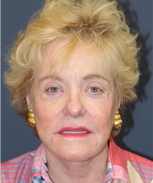 Facelift After Photo by Laurence Glickman, MD, MSc, FRCS(c),  FACS; Garden City, NY - Case 44795