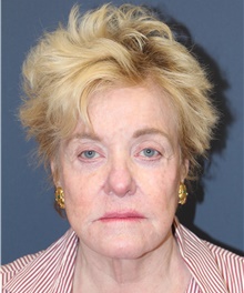 Facelift Before Photo by Laurence Glickman, MD, MSc, FRCS(c),  FACS; Garden City, NY - Case 44795