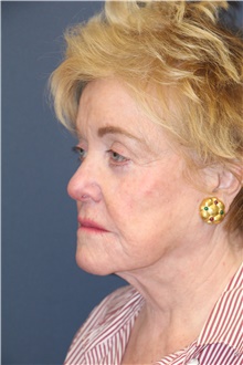 Facelift Before Photo by Laurence Glickman, MD, MSc, FRCS(c),  FACS; Garden City, NY - Case 44795