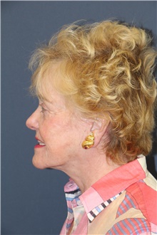 Facelift After Photo by Laurence Glickman, MD, MSc, FRCS(c),  FACS; Garden City, NY - Case 44795