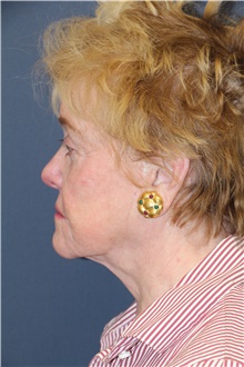 Facelift Before Photo by Laurence Glickman, MD, MSc, FRCS(c),  FACS; Garden City, NY - Case 44795