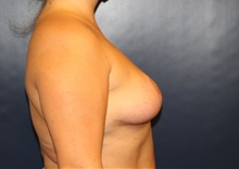 Breast Reduction After Photo by Laurence Glickman, MD, MSc, FRCS(c),  FACS; Garden City, NY - Case 44797