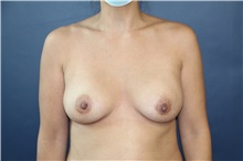 Breast Augmentation After Photo by Laurence Glickman, MD, MSc, FRCS(c),  FACS; Garden City, NY - Case 44798