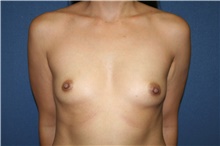 Breast Augmentation Before Photo by Laurence Glickman, MD, MSc, FRCS(c),  FACS; Garden City, NY - Case 44798