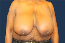 Breast Reduction Before Photo by Laurence Glickman, MD, MSc, FRCS(c),  FACS; Garden City, NY - Case 44801
