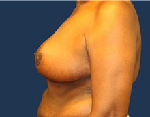 Breast Reduction After Photo by Laurence Glickman, MD, MSc, FRCS(c),  FACS; Garden City, NY - Case 44801