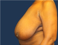 Breast Reduction Before Photo by Laurence Glickman, MD, MSc, FRCS(c),  FACS; Garden City, NY - Case 44801