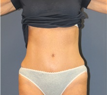 Tummy Tuck After Photo by Laurence Glickman, MD, MSc, FRCS(c),  FACS; Garden City, NY - Case 44802