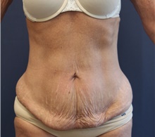 Tummy Tuck Before Photo by Laurence Glickman, MD, MSc, FRCS(c),  FACS; Garden City, NY - Case 44802
